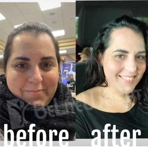 Sleeve to RNY Bypass Revision